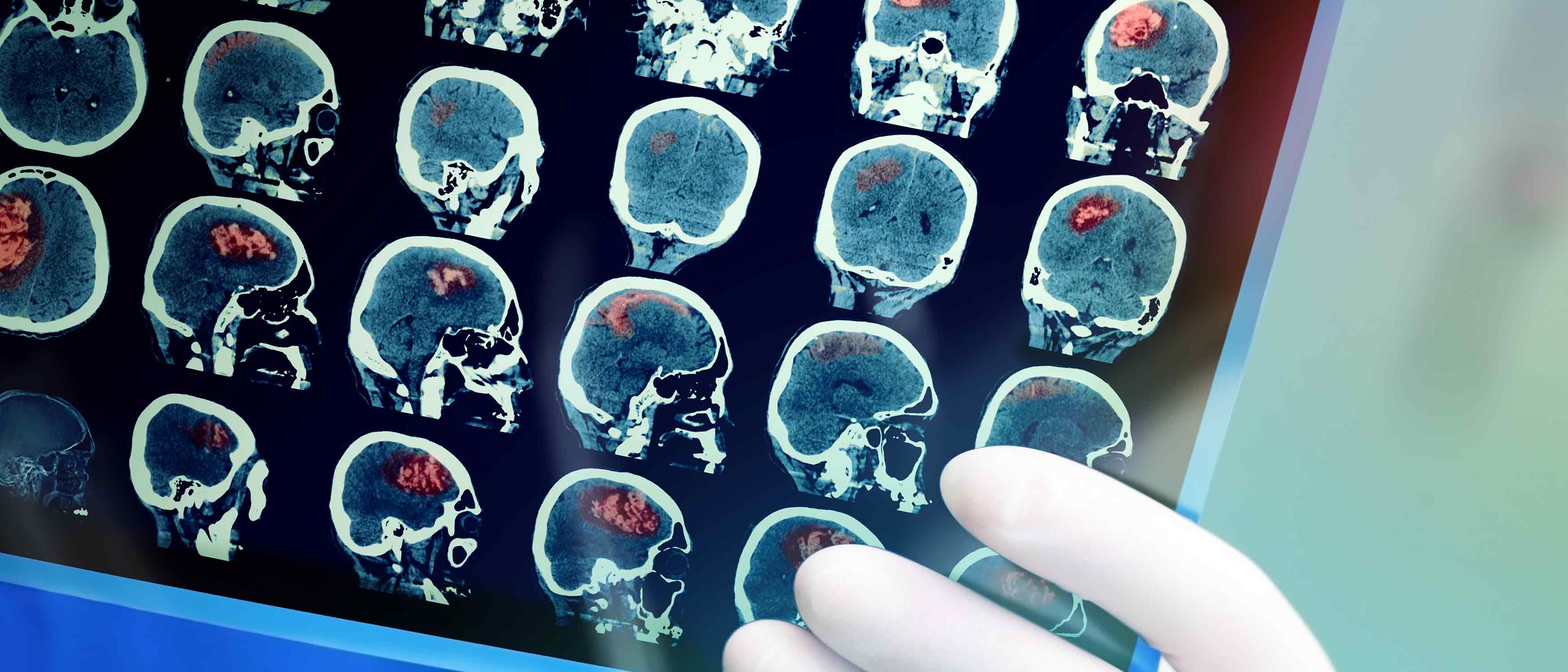 Los Angeles Traumatic Brain Injury Lawyer | TBI Attorney